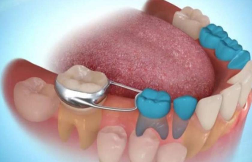 حافظ المسافة في أسنان الأطفال