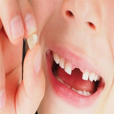تسوس الأسنان اللبنية عند الرضع
