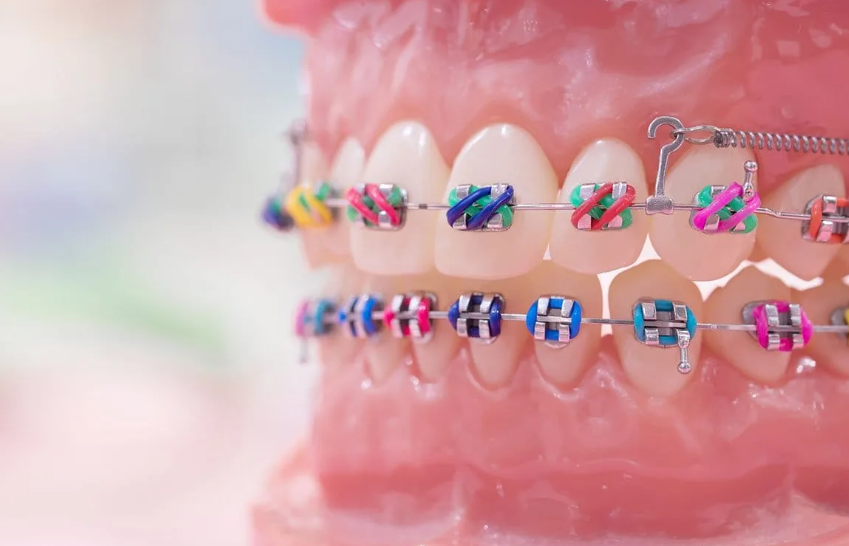 هل تقويم الأسنان عند الكبار مثل تقويم الصغار؟