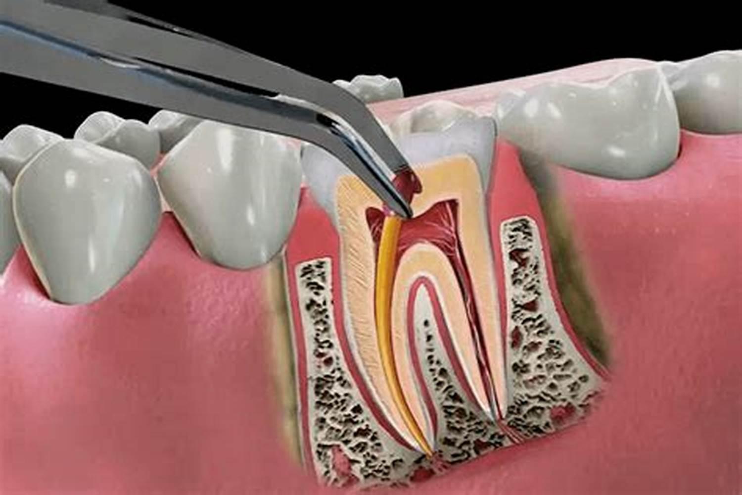 أسباب فشل علاج العصب ..لماذا يعود الألم بعد العلاج؟