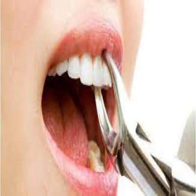 تعليمات يجب اتباعها بعد عملية خلع الأسنان