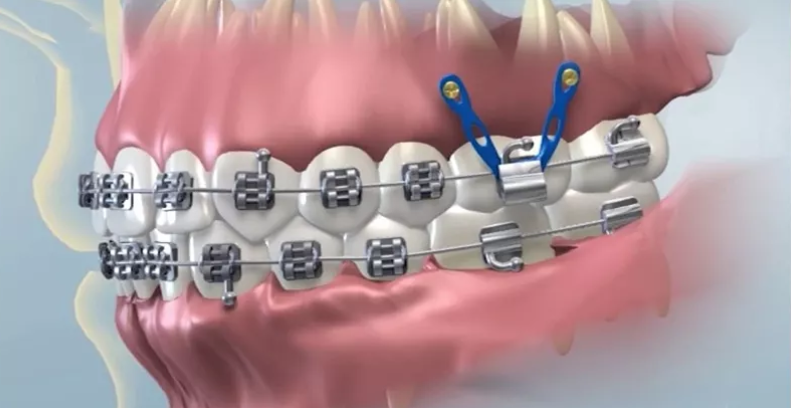 الزرعات التقويمية (Orthodontic Mini-Implants): مفهومها وفوائدها في علاج تقويم الأسنان