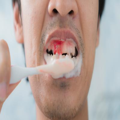 الاسعافات الأولية لنزيف اللثة او الأسنان