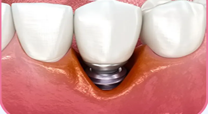 هل التهاب اللثة حول الزرعة يعني فشلها؟