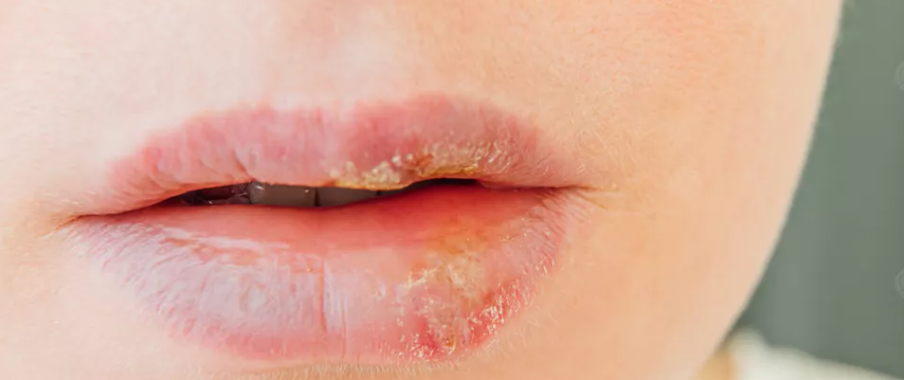 جفاف الفم: الأسباب، الأعراض وطرق الوقاية