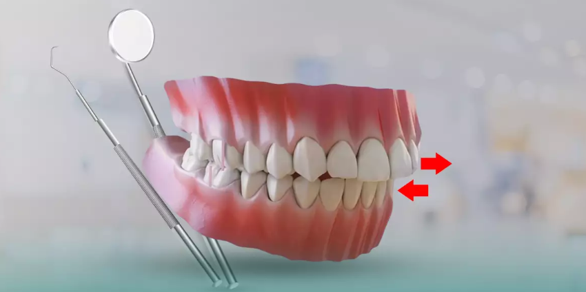 بروز الفك .. الأسباب و العلاج