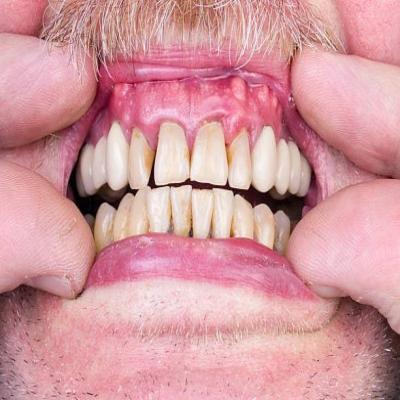 مشاكل اللثة الشائعة مع التقدم في العمر