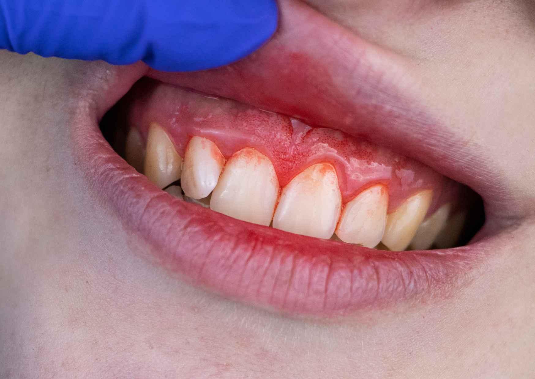 تأثير أمراض اللثة على فقدان الأسنان على المدى الطويل